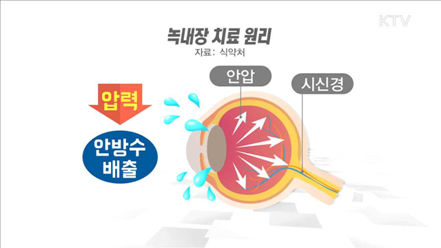 "녹내장 치료제, 바르게 사용하세요"