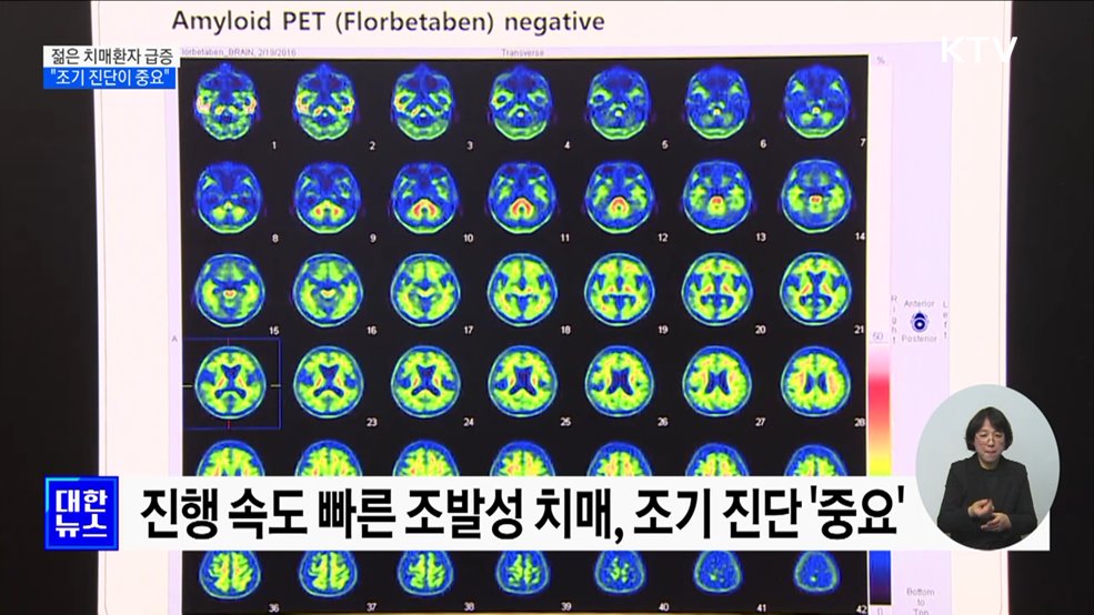 '젊은 치매' 조발성 치매 급증···"조기 진단이 중요"