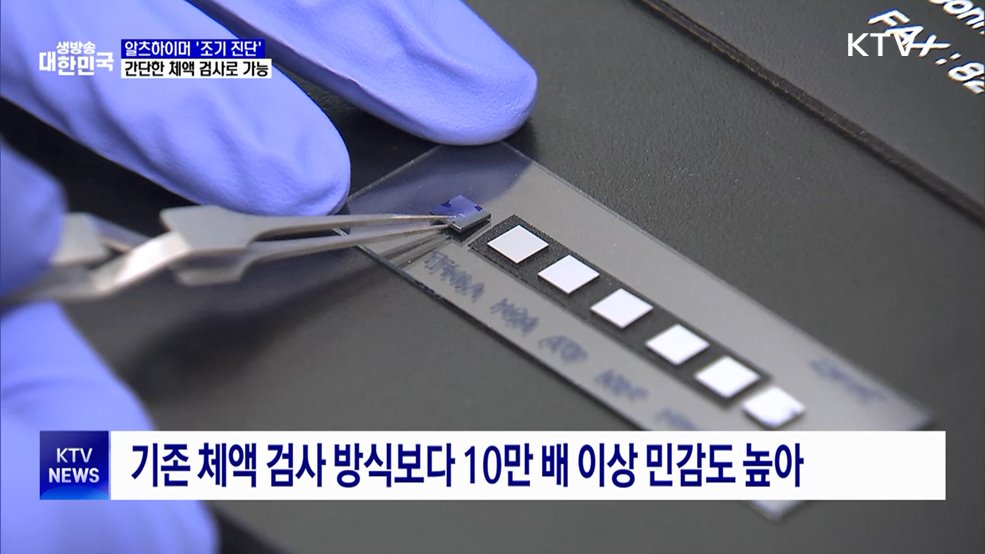 알츠하이머 '조기 진단' 혁신···간단한 체액 검사로 가능