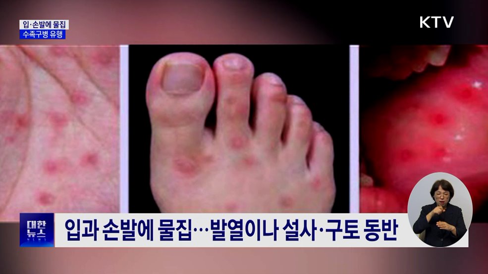영유아 수족구병 급증···"감염 시 외출 자제"