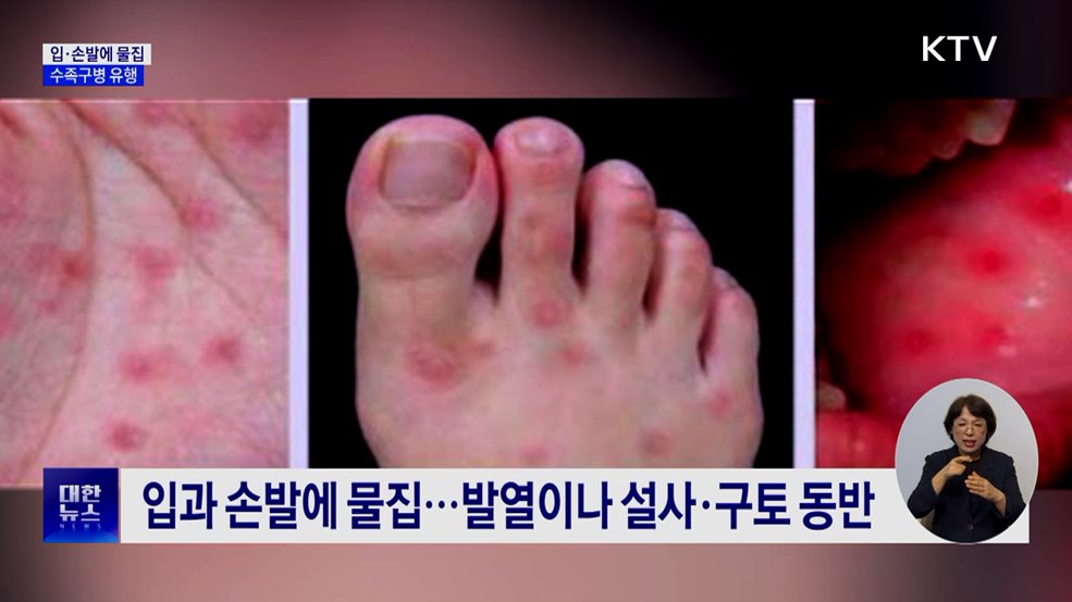 영유아 수족구병 급증···"감염 시 외출 자제"