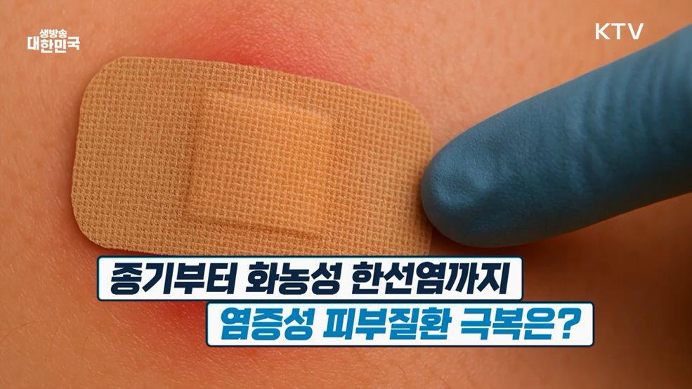 '자꾸 반복되는 종기' 화농성 한선염 극복법 [건강 365]