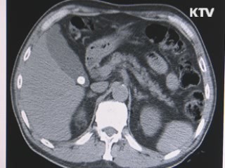 "무리한 다이어트도 담석의 원인"