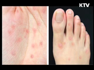 영유아, 여름철 수족구병 '주의보'