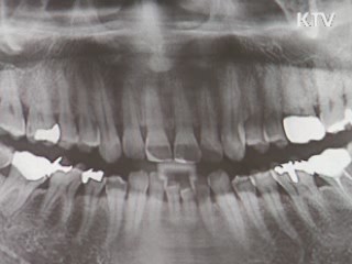 다음달부터 노인 완전틀니 수리도 보험 적용