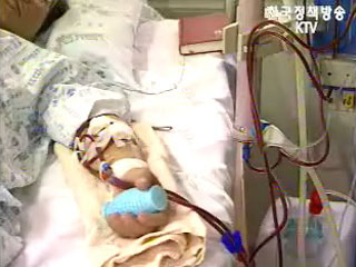 부적격 혈액 수혈자 8명 B형 간염 감염 확인