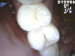 어린이 충치`줄었다`