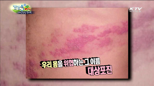 우리 몸을 위협하는 그 이름 대상포진