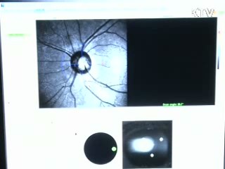 노인 개안수술 12억 8천만원 지원