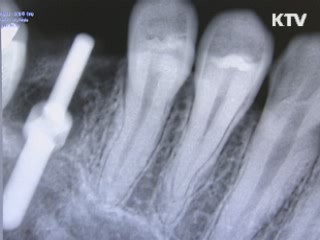 오산보건소 '무료틀니 사업' 시행