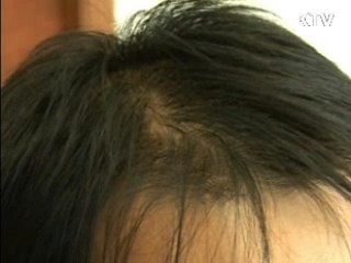 탈모증 진료 환자 절반이 20~30대