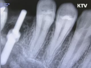 오산보건소 '무료틀니 사업' 시행